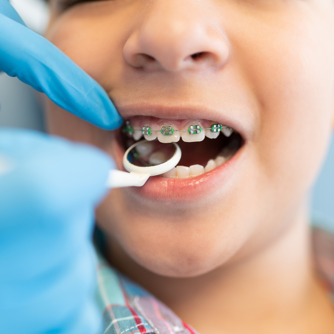 fame Unarmed Spread Aparat dentar pentru copii / Ortodontie copii - 5Dent - 5dent