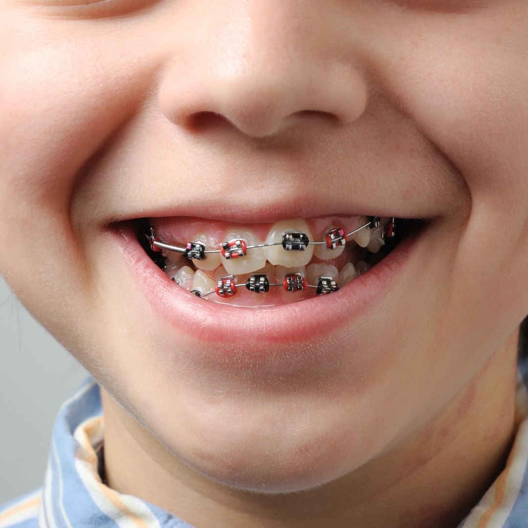 U.S. dollar Sale Daisy Aparat dentar pentru copii / Ortodontie copii - 5Dent - 5dent